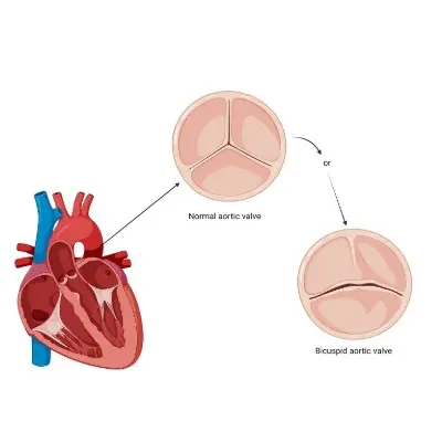 Bicuspid Aortic Valve in Children: Symptoms and Treatment